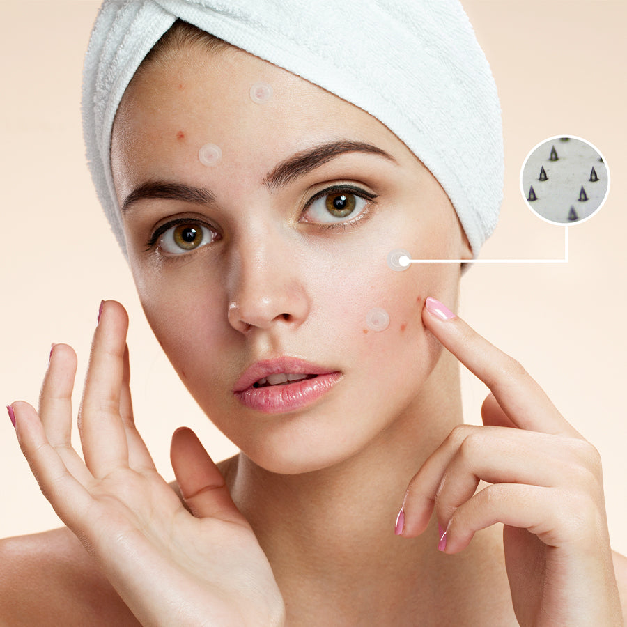 Acne Microneedle Patches | Dissolving Microneedle Beauty